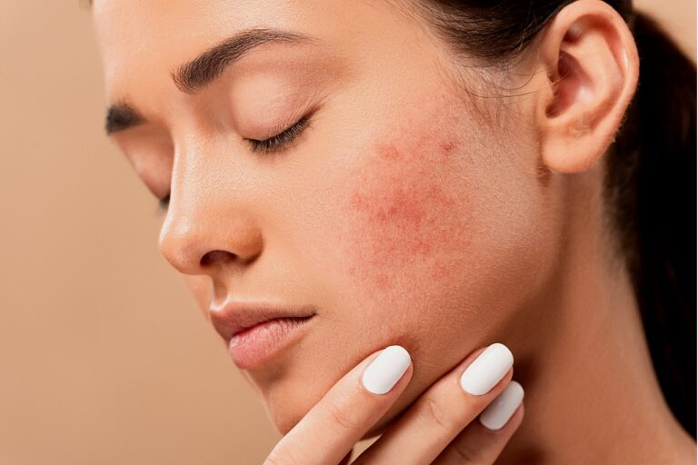 Prevenzione acne