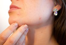 Problemi di acne consigli